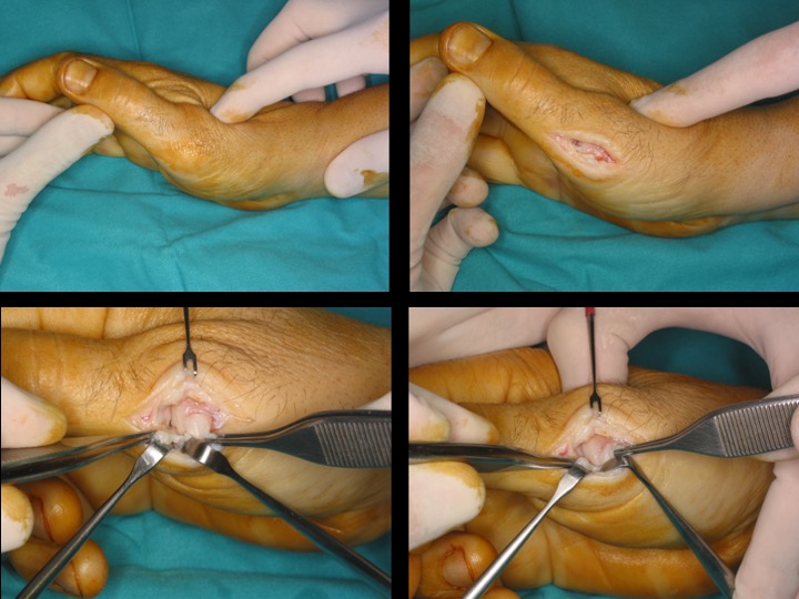 Figure 3 for case Complete proximal tear of the radial collateral ligament of the MPJ of the thumb